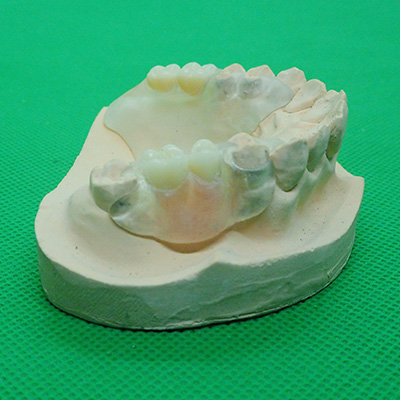 ノンクラスプデンチャー